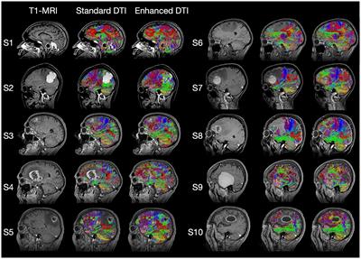 Preoperative validation of edema-corrected tractography in neurosurgical practice: translating surgeon insights into novel software implementation